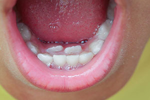 Example of "shark teeth" in babies.